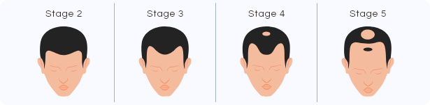 Norwood scale diagram