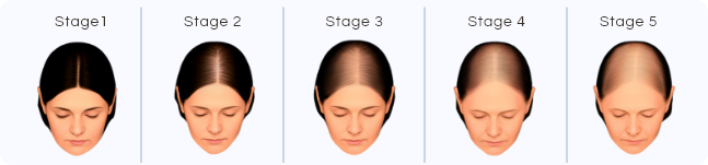 Sinclair scale stages I-V