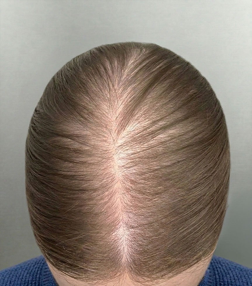 Female pattern hair loss — part line thinning