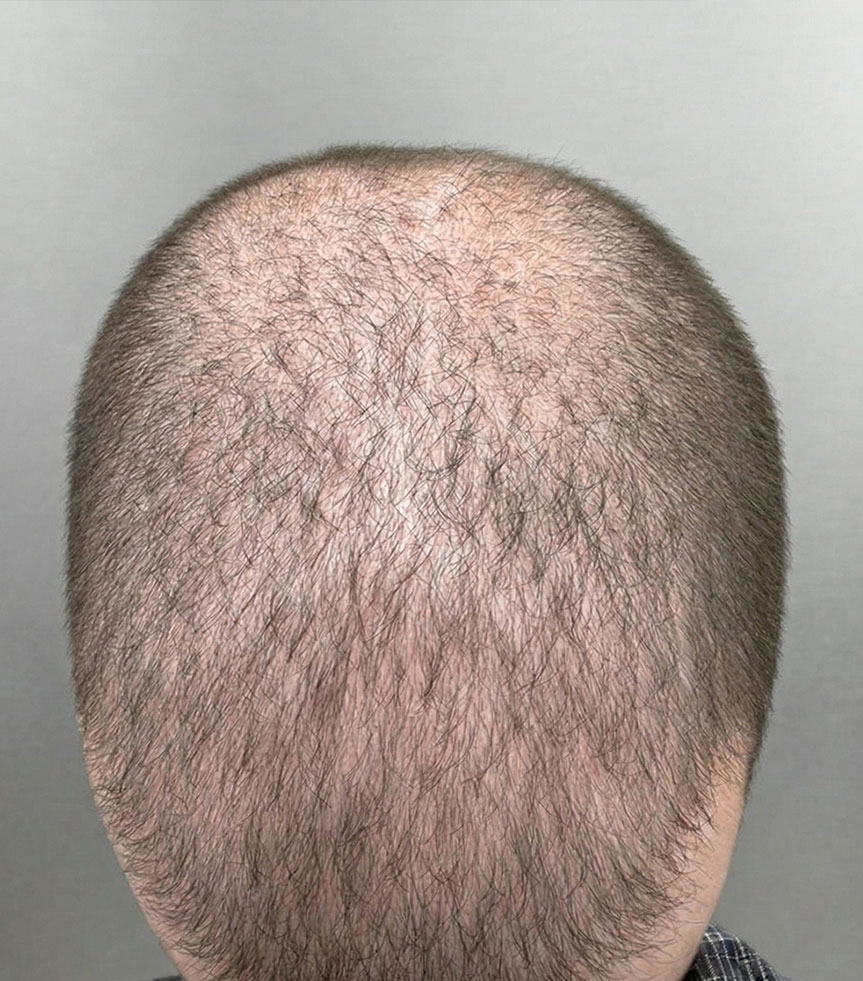 Male pattern hair loss — crown thinning
