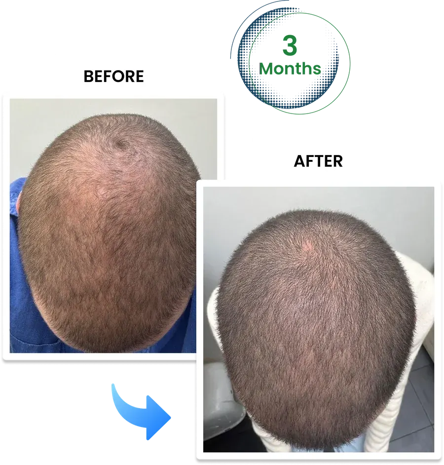 Before and after hair loss treatment results